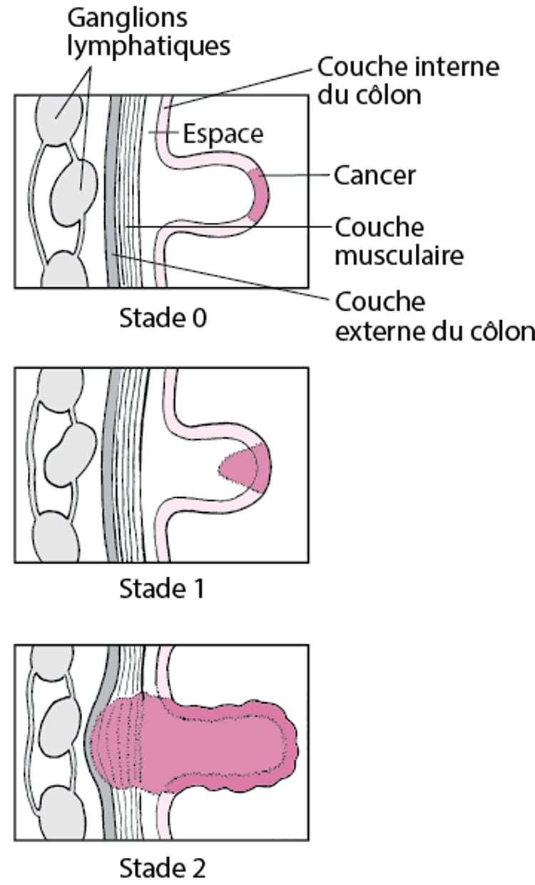Classification du cancer du côlon