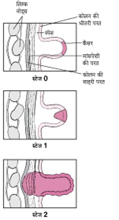 स्टेजिंग कोलोन कैंसर