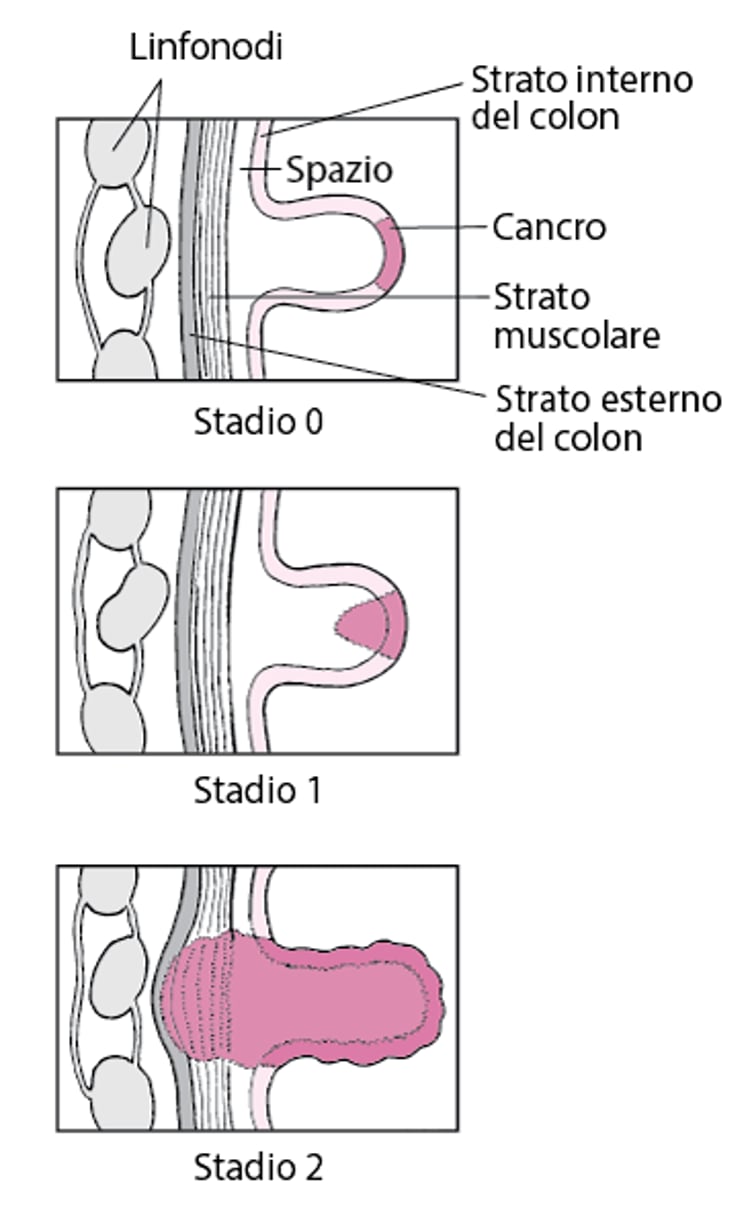 Stadiazione del tumore del colon