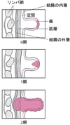 結腸がんの病期診断