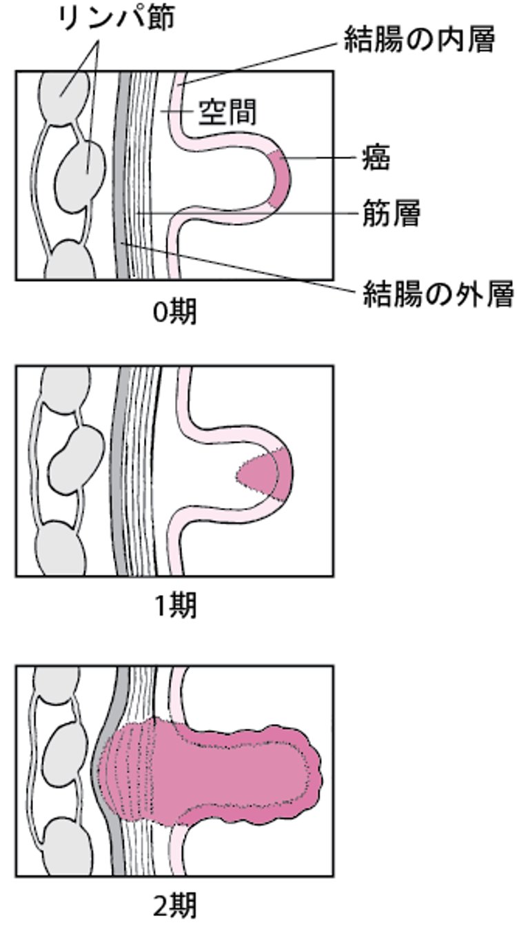 結腸がんの病期診断