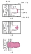 결장암의 단계별 진행 과정
