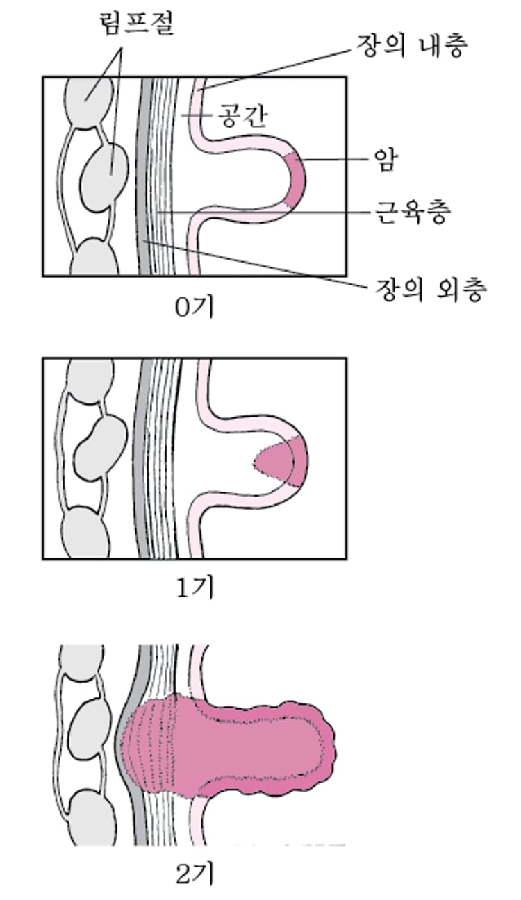 결장암의 단계별 진행 과정