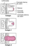 Estágios do câncer de cólon