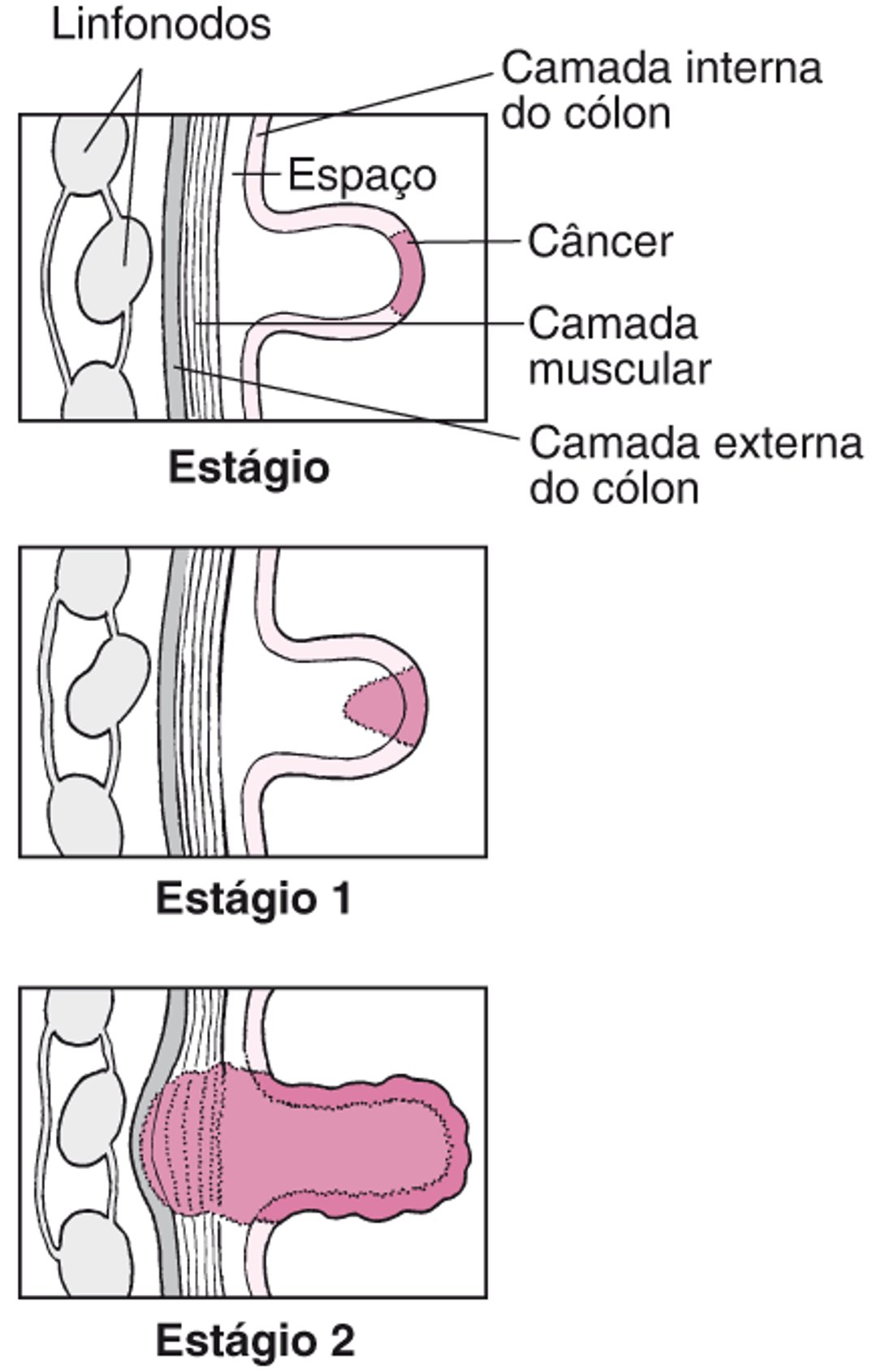 Estágios do câncer de cólon