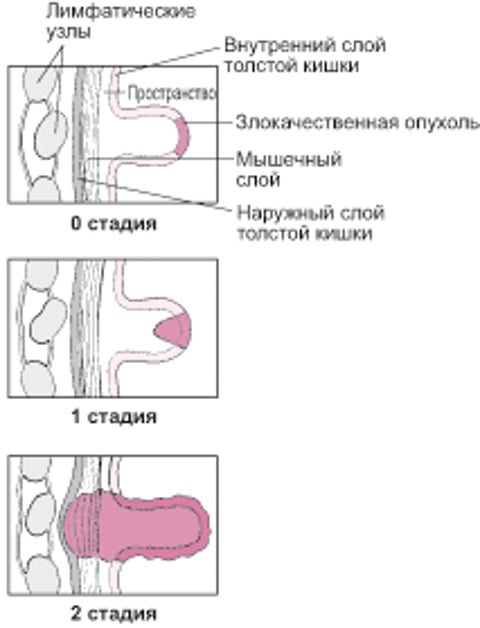 Стадийность рака толстой кишки