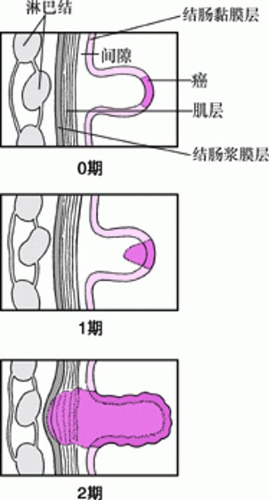 结肠癌分期