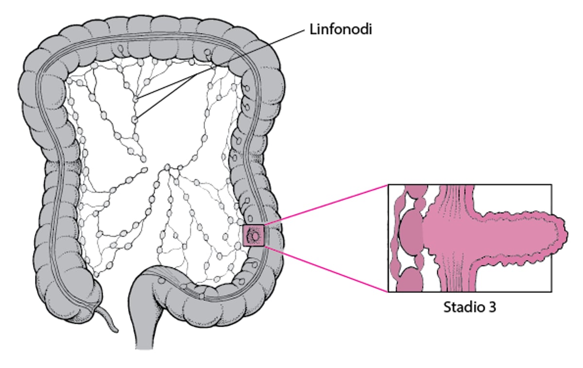 Stadiazione del tumore del colon