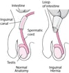 What Is an Inguinal Hernia?