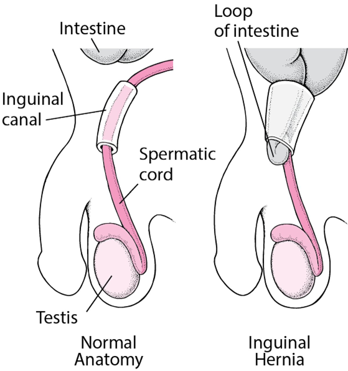 What Is an Inguinal Hernia?