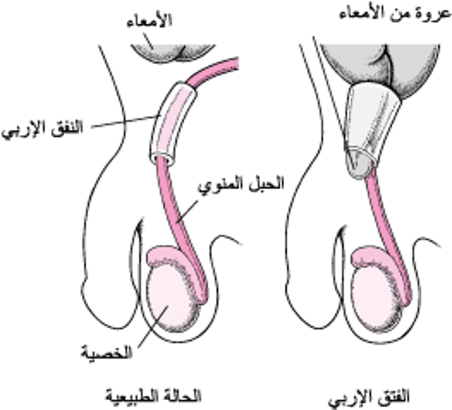 ما هو الفتق الأربي؟