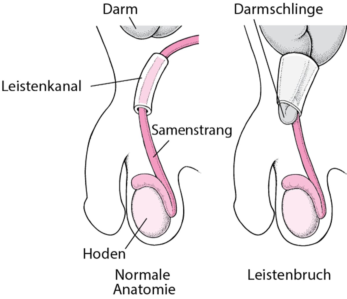 Was ist eine Leistenhernie?
