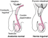 ¿Qué es una hernia inguinal?