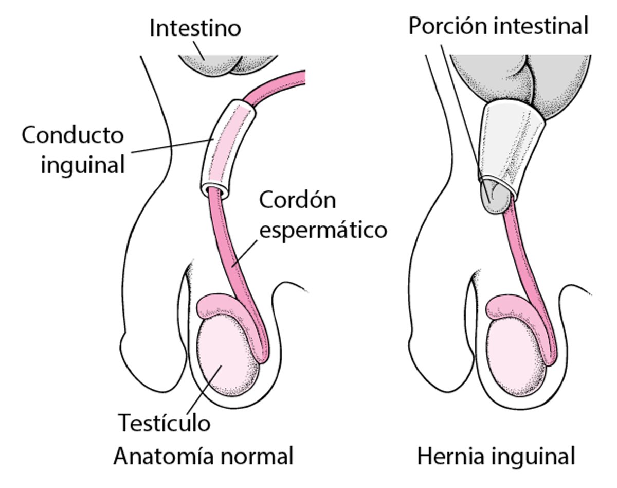 ¿Qué es una hernia inguinal?