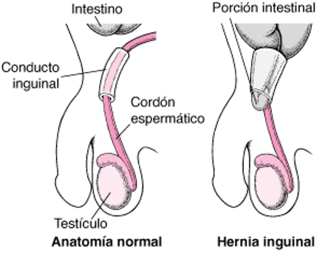 ¿Qué es una hernia inguinal?