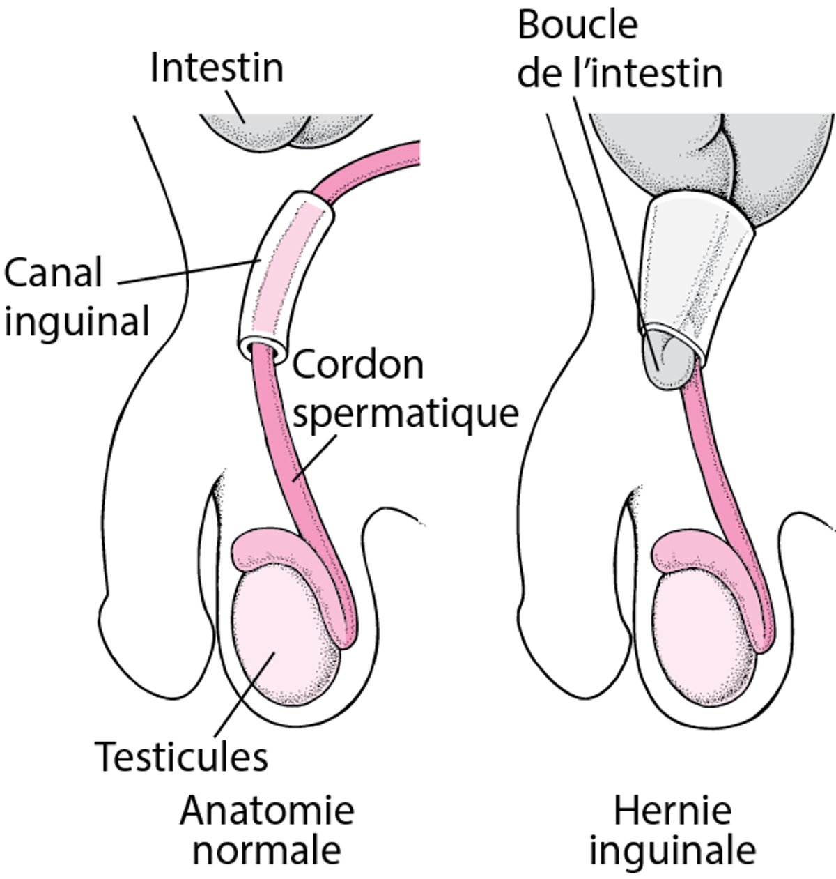 Qu’est-ce qu’une hernie inguinale ?