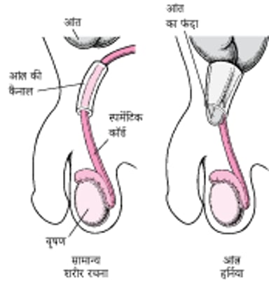 इंगुइनल हर्निया क्या है?