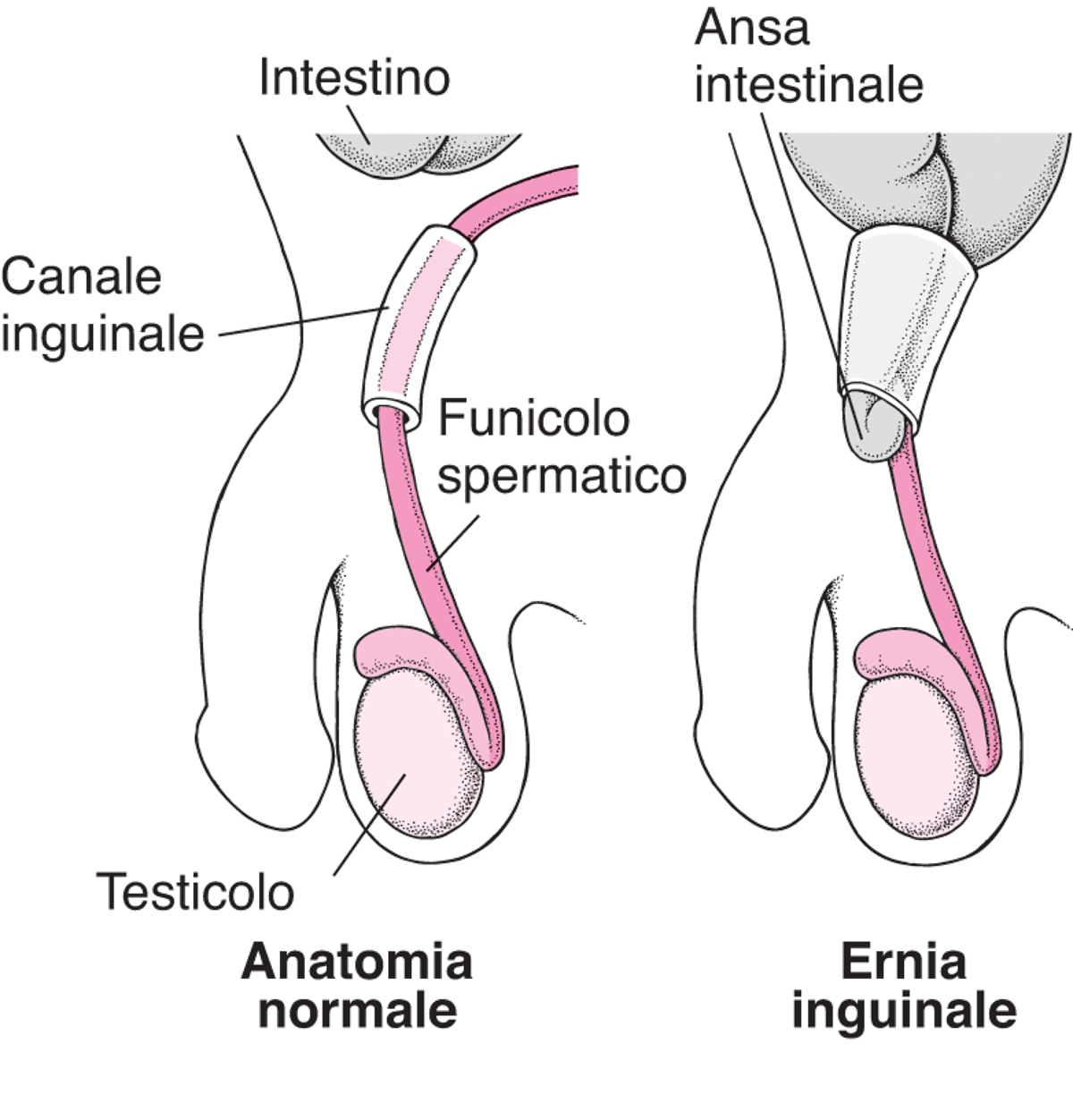 Che cos’è un’ernia inguinale?