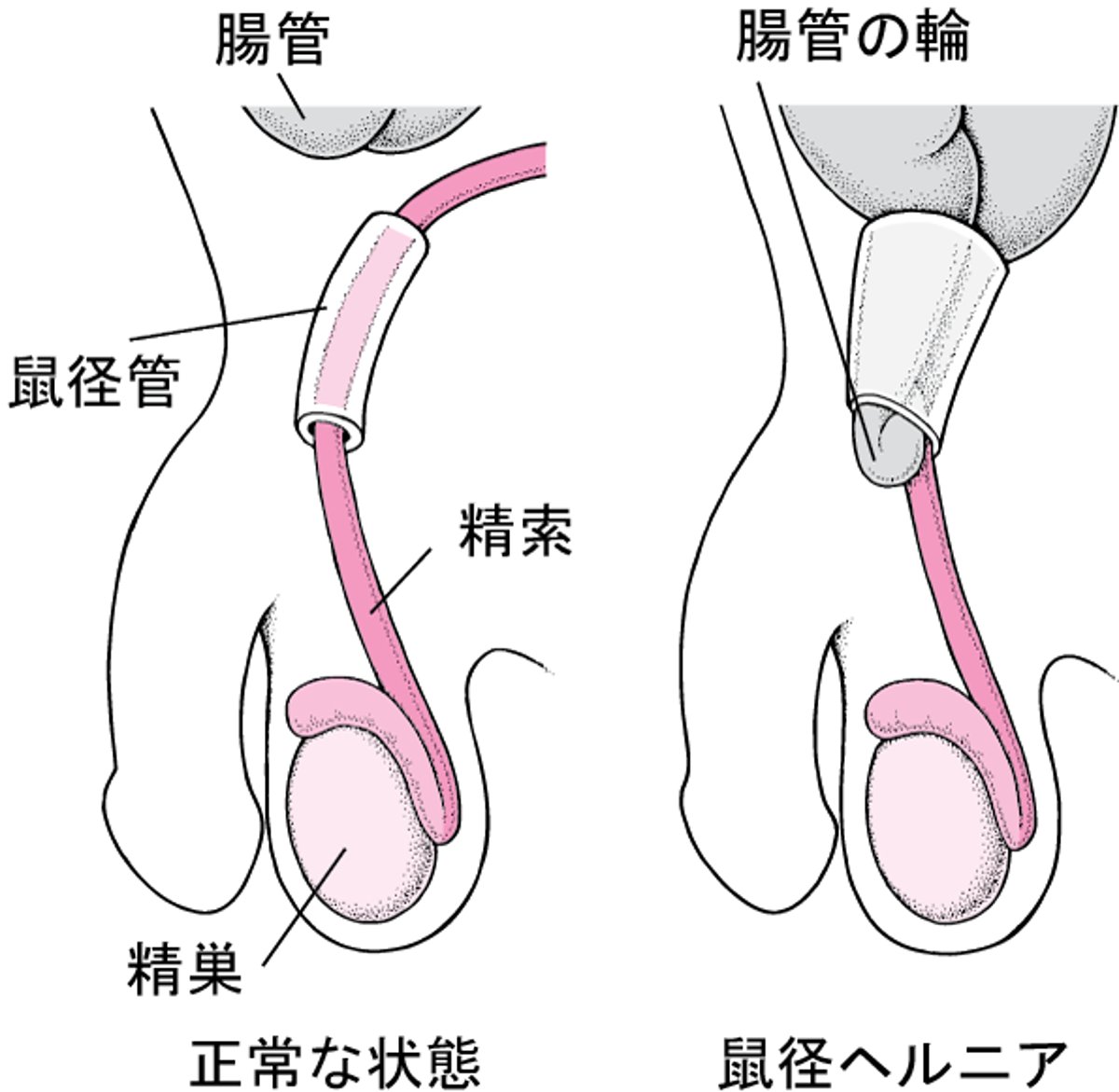 鼠径ヘルニアとは