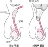 사타구니 탈장이란 무엇입니까?