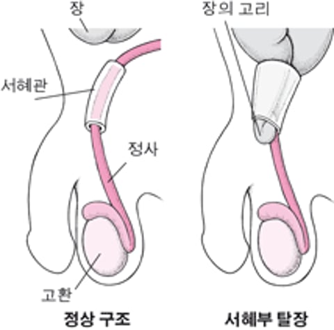 사타구니 탈장이란 무엇입니까?