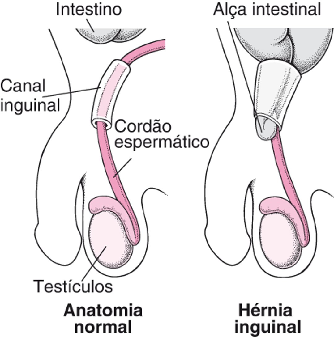 O que é uma hérnia inguinal?