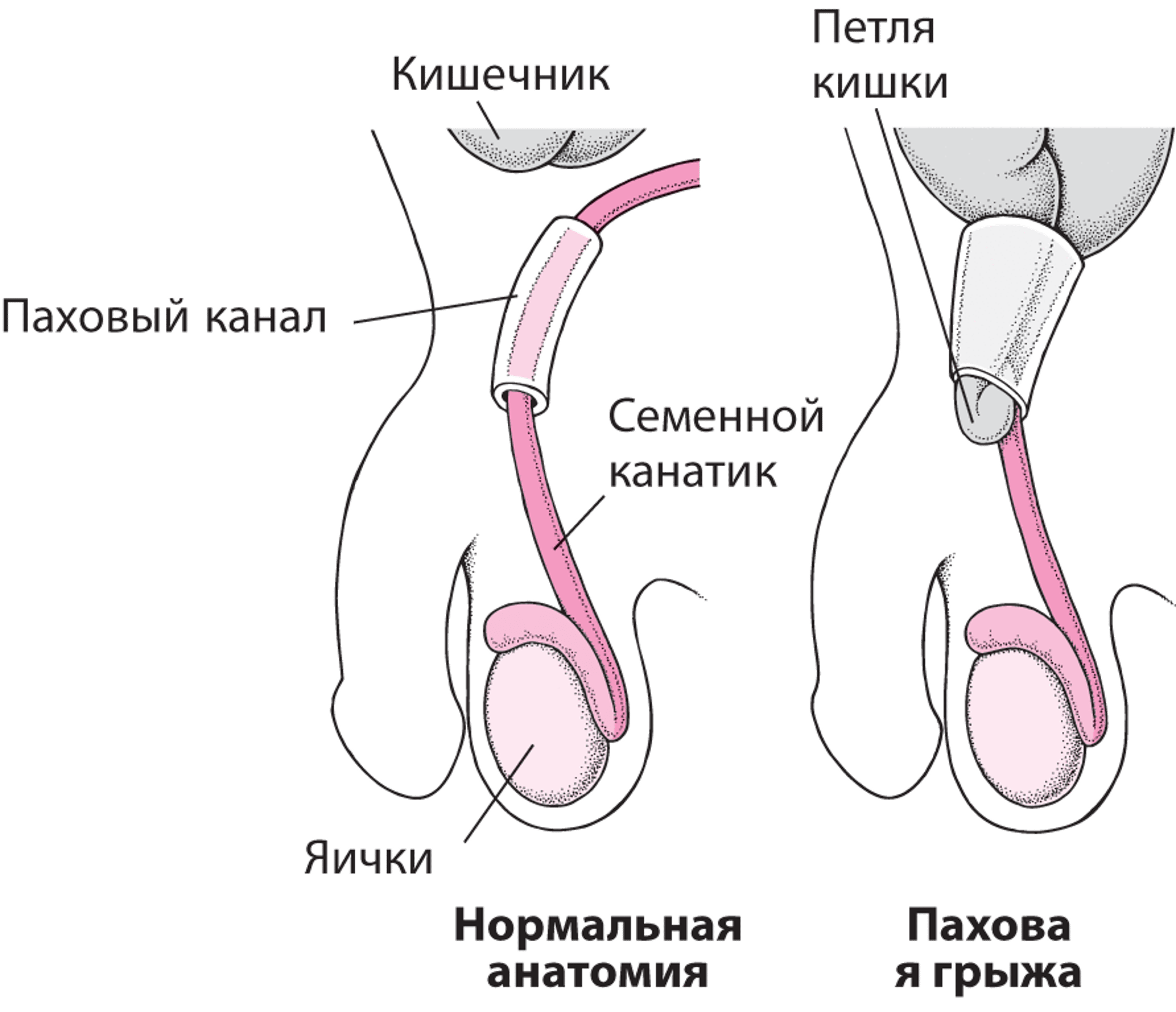 Что такое паховая грыжа?