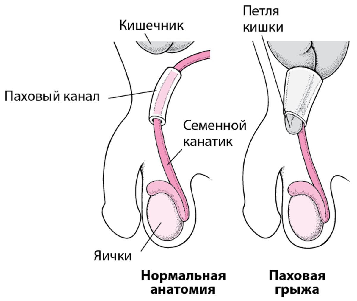 Что такое паховая грыжа?