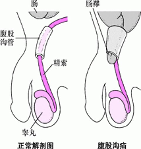 什么是腹股沟疝？