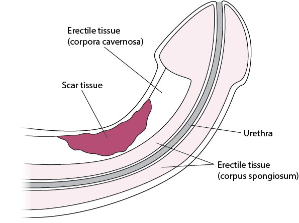 Image What Is Peyronie Disease Merck Manual Consumer Version