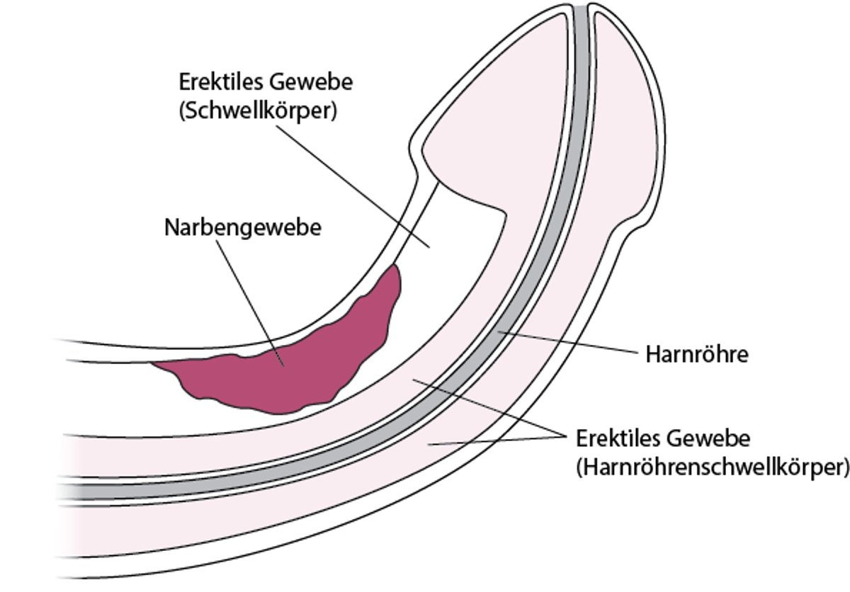 Was ist die Peyronie-Krankheit?
