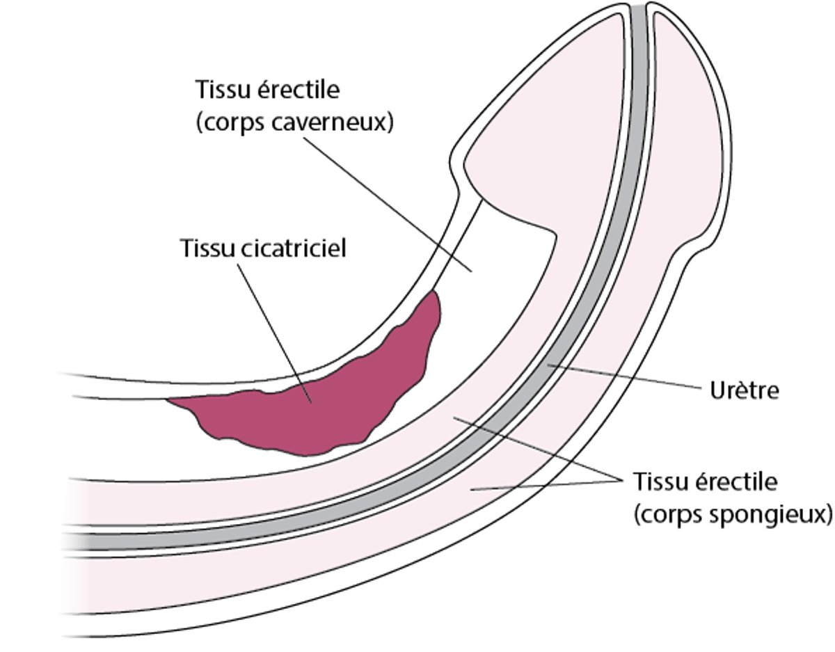 Qu’est-ce que la maladie de La Peyronie ?