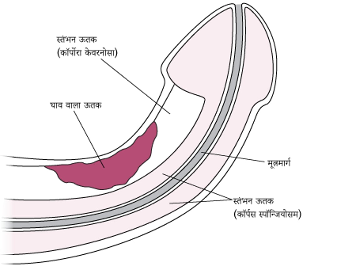 पेरोनी रोग क्या है?