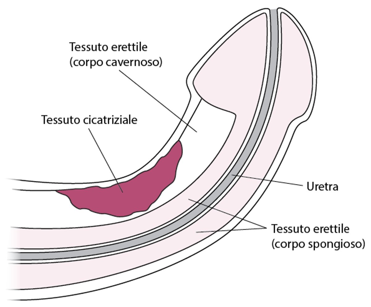 Cos’è la malattia di Peyronie?