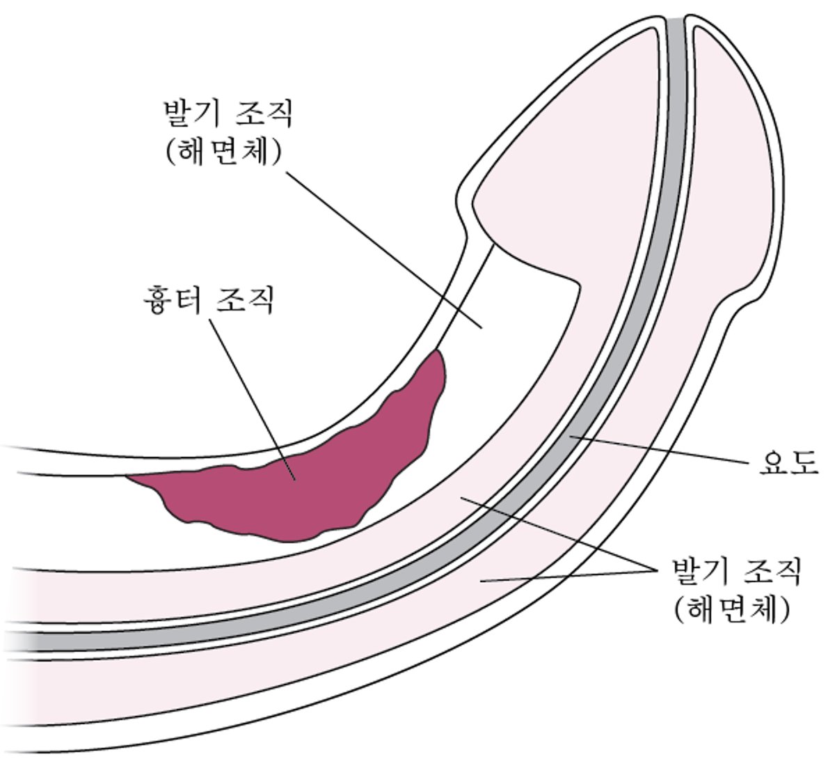 페이로니병이란 무엇입니까?