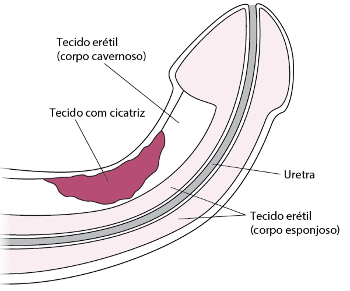 O que é a doença de Peyronie?