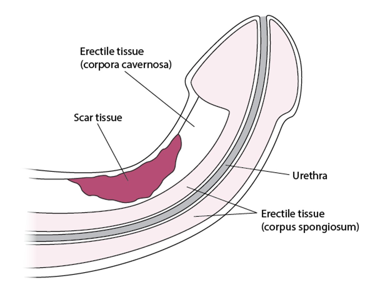 什么是阴茎硬结症？