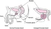 What Happens When the Prostate Gland Enlarges?