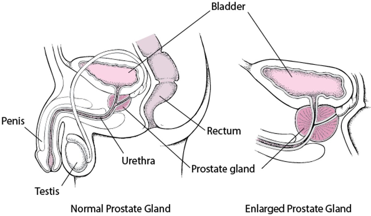 Was passiert, wenn sich die Prostata vergrößert?