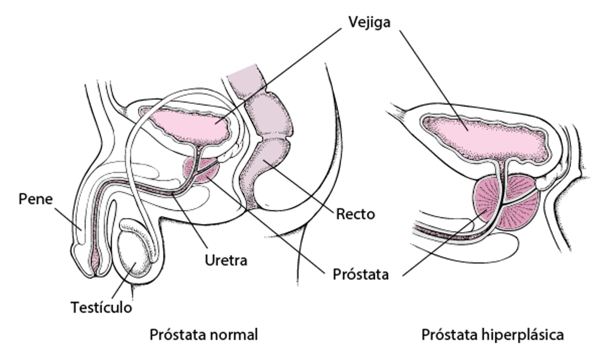 ¿Qué sucede cuando la próstata aumenta de tamaño?