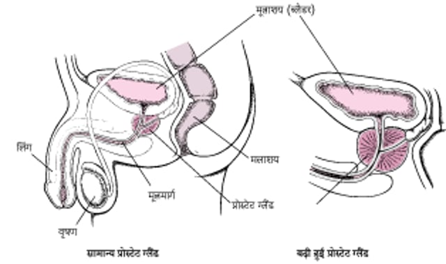 प्रोस्टेट ग्लैंड के बढ़ने पर क्या होता है?