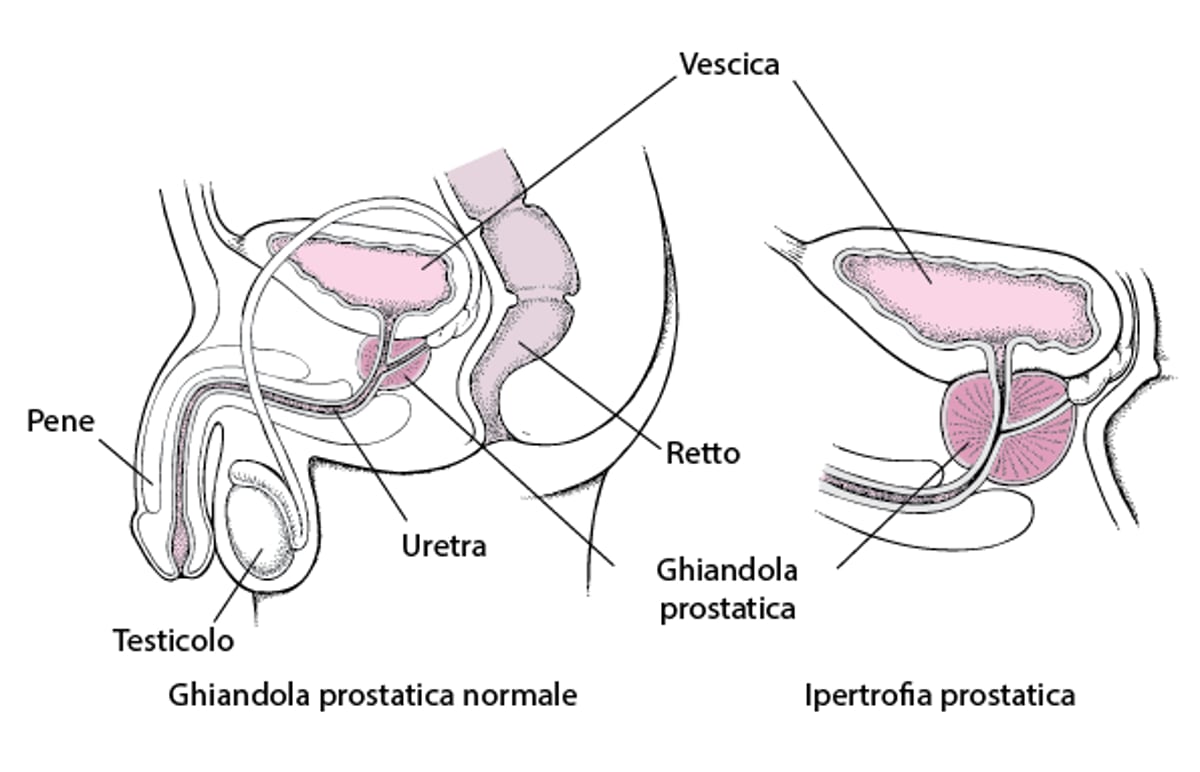 Che cosa accade quando la ghiandola prostatica si ingrossa?