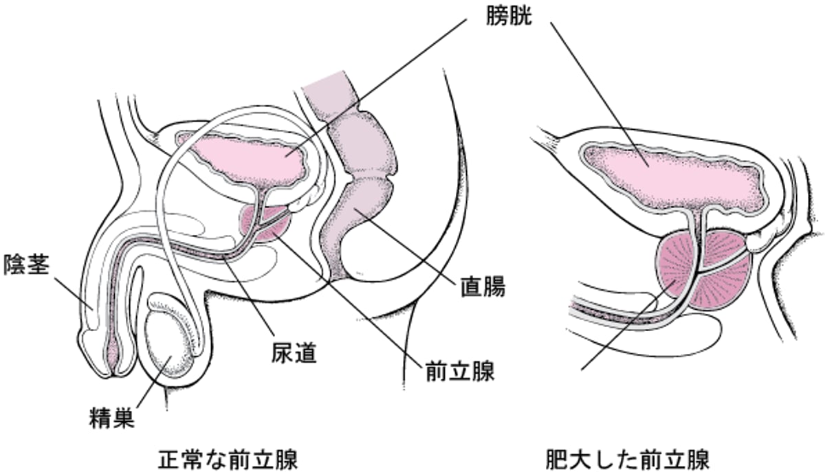 前立腺が大きくなると何が起こりますか？