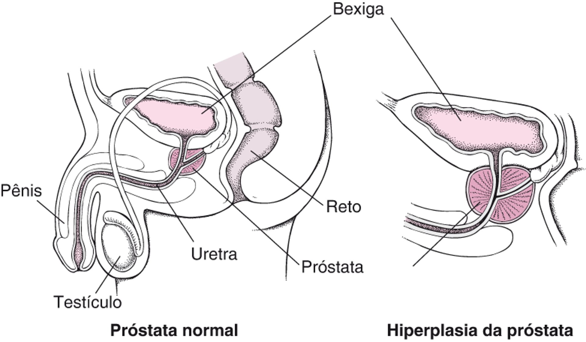 O que acontece quando a glândula prostática aumenta?