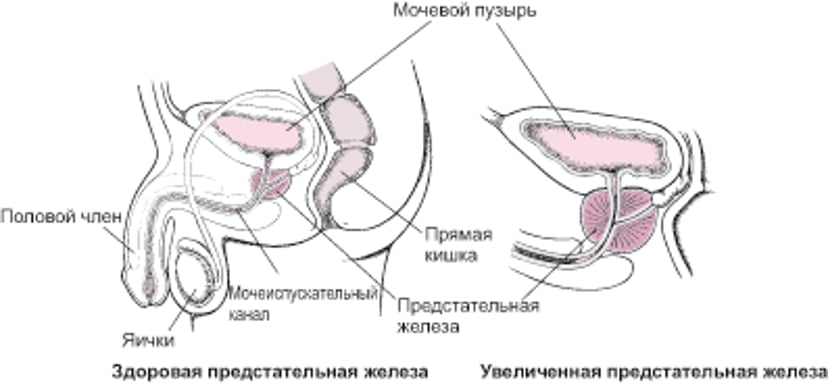 Что происходит при увеличении предстательной железы?