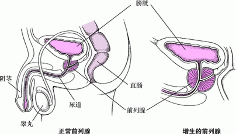 前列腺增大时会发生什么？