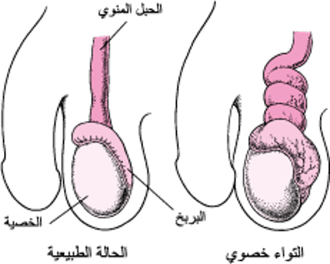 ما هُو التواءُ الخصية؟