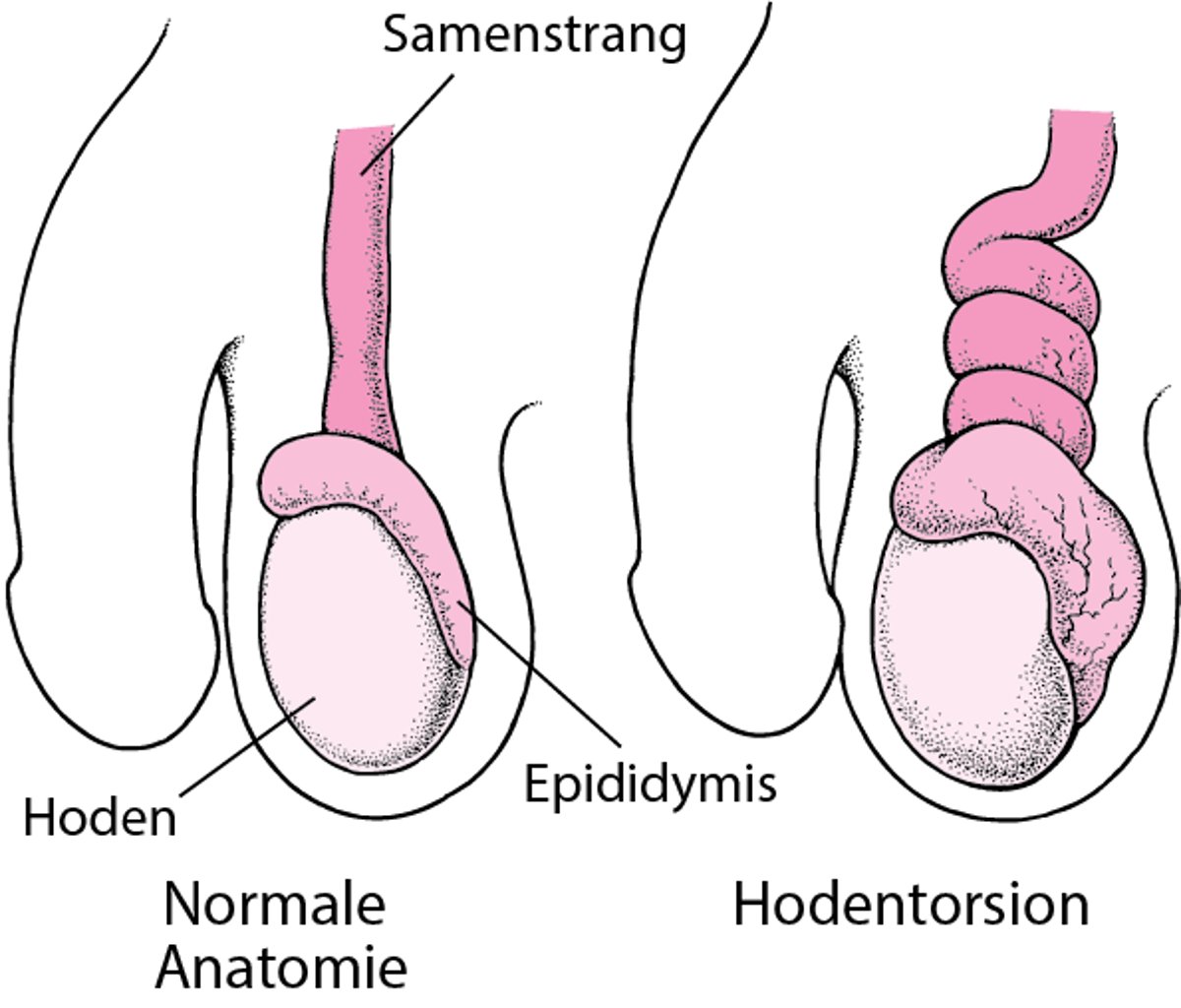 Was versteht man unter Hodentorsion?