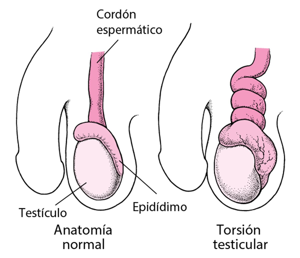 ¿Qué es la torsión testicular?