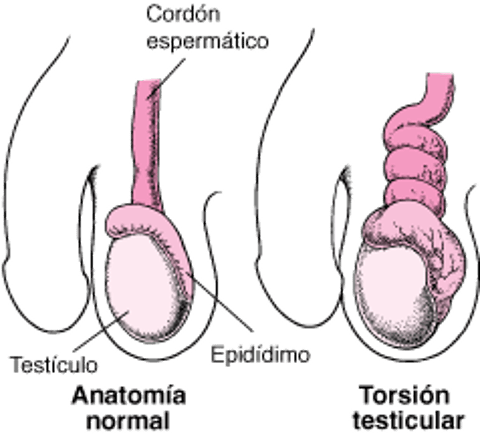 ¿Qué es la torsión testicular?